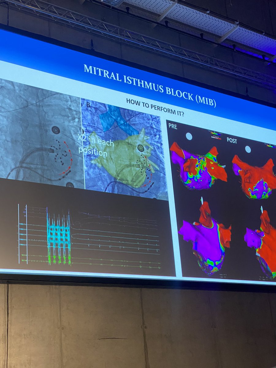 Great presentation on PFA beyond PVI from @Raquel_Adelino on feasibility, practical considerations and safety at the #PFASummit ! Thanks for sharing our data from #StGeorgHeart #EHRA