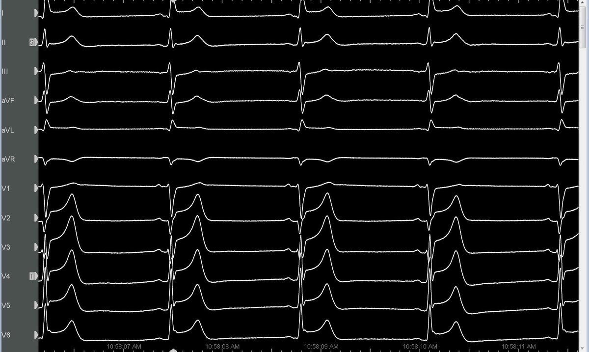 Yuksek Ihtisas Arrhythmia- Ankara City Hospital tweet media