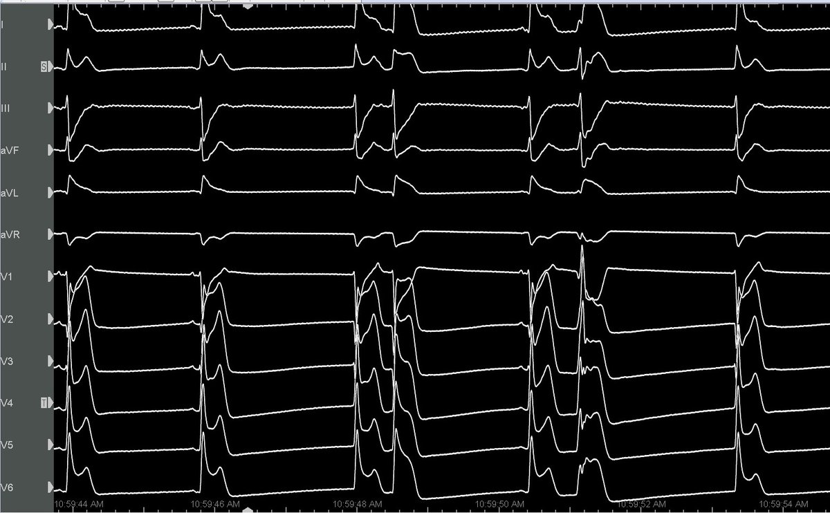 Yuksek Ihtisas Arrhythmia- Ankara City Hospital tweet media
