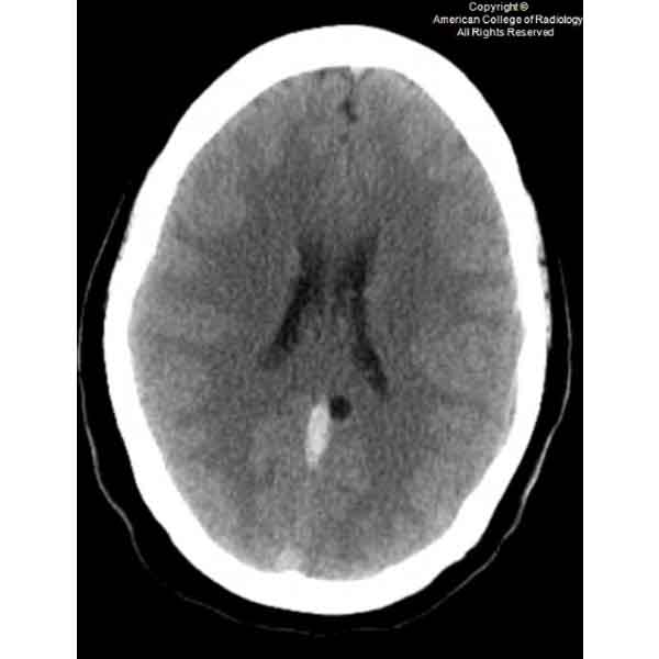 A 36-year-old hypertensive woman presents to the emergency department with acute aphasia. #ACRCaseinPoint bit.ly/49dVlRM