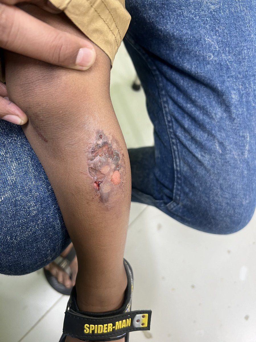 Tiny toddler Spider-Men are at risk of scalds from metal play equipment in hot summer weather. 

Weather proof your kid’s playtime and play equipment. 

This 👇 was one such accident. 

#ChildHealthMatters #KidsSafety