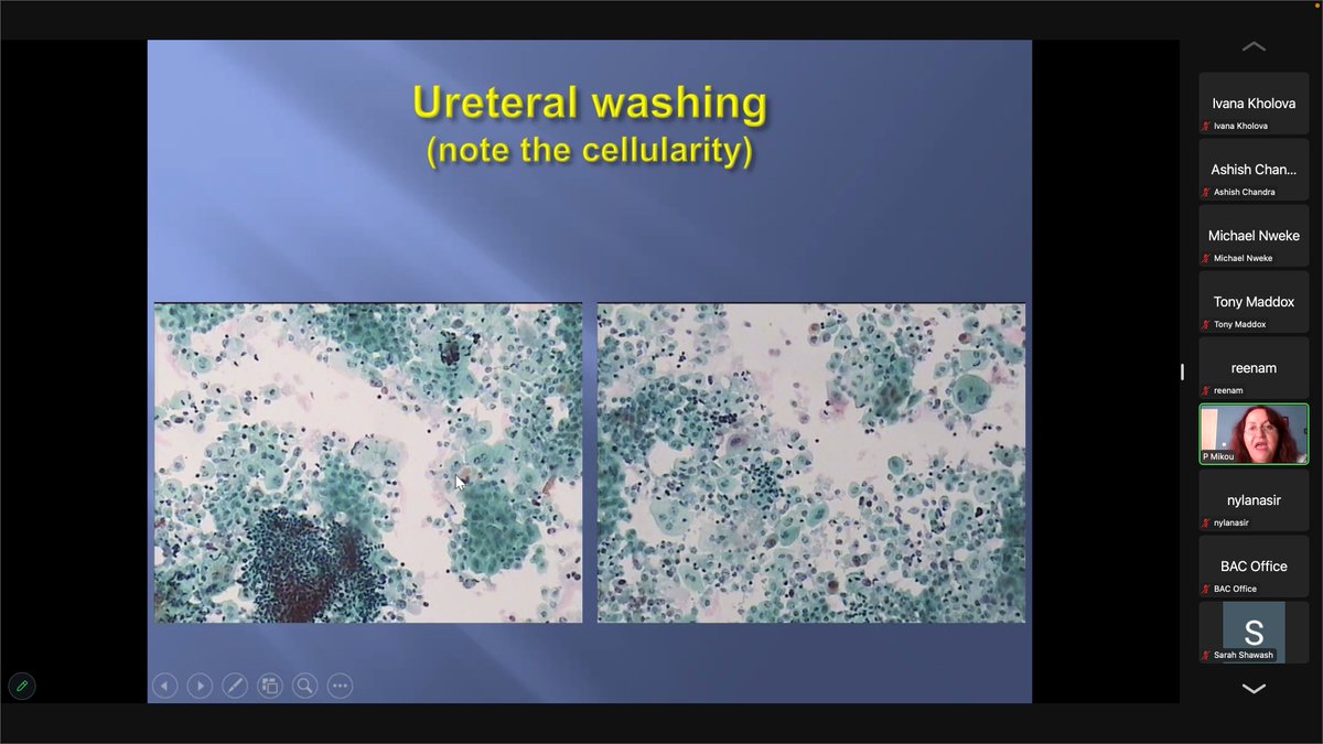 The BAC Spring tutorial. Dr @MikouPanagiota presents urinary tract cytology. 'Cellularity is not a criterion for malignancy' in instrumented samples. @britishcytology @IACytology @IBMScience @PathologyHouse Best wishes to all trainees doing the FRCPath exam next week 🙂🙏