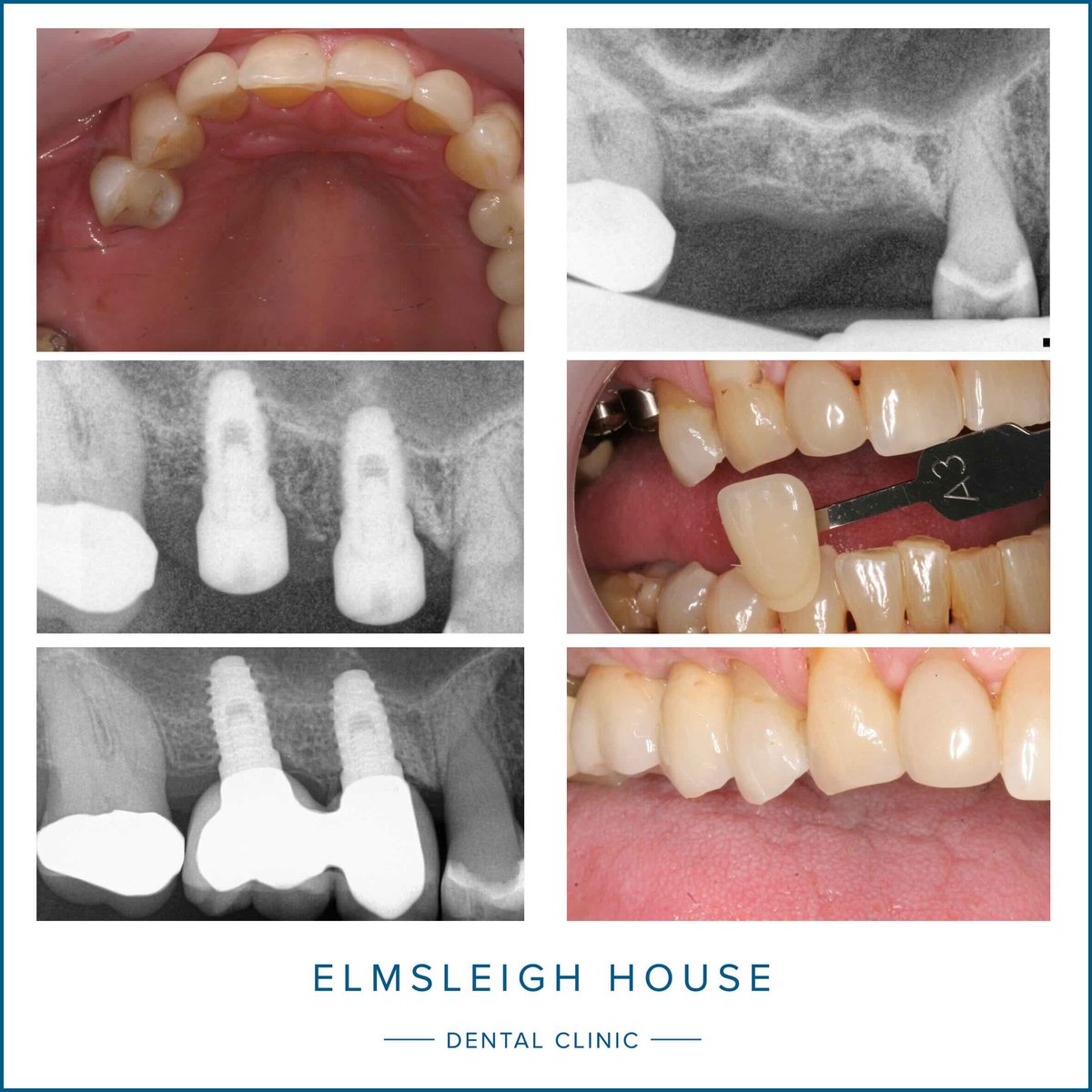 Kit Spears performed two mini sinus lifts with regenerative techniques and placed two dental implants and implant-retained crowns to replace Mrs B's missing teeth

Read our blog - elmsleighhouse.co.uk/blog/mini-sinu…

#ElmsleighDental #dentalimplants #DrKitSpears #FarnhamDentist #HappyPatient