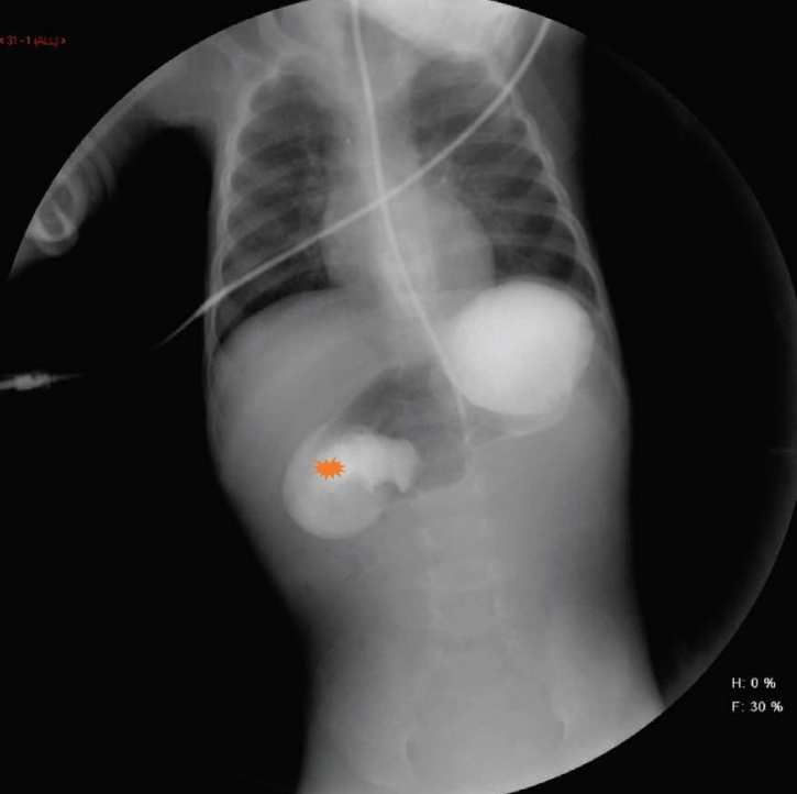 Not all palpable 'olives' are due to pyloric stenosis Duodenal web the culprit here with typical 'windsock sign' upon introduction of contrast tinyurl.com/4z3wdc77 #neoTwitter