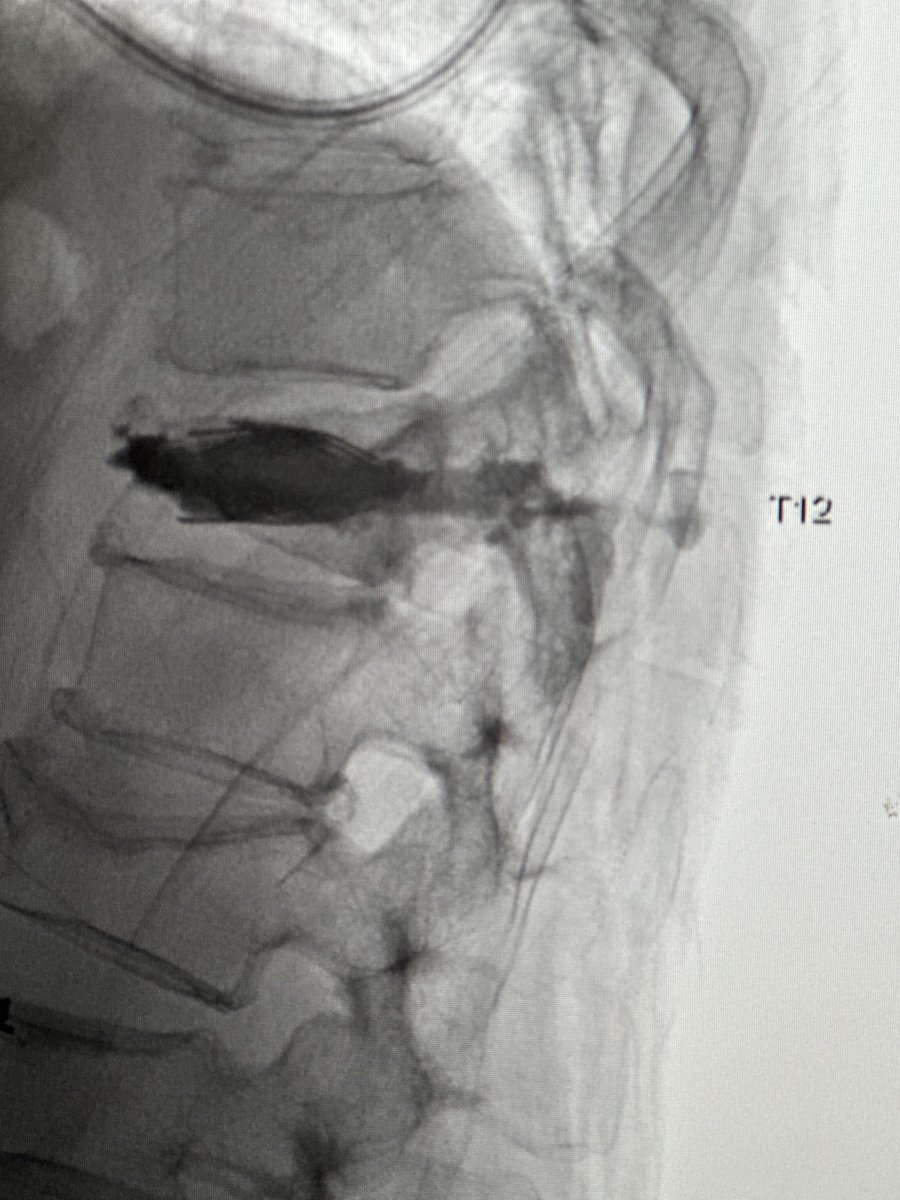 With this flat/comminuted burst fracture I was concerned about cement leakage limiting how much I could fill. #SpineJack to the rescue! This system allowed partial height restoration and control of cement in a really small space. Especially great tool for these types of cases