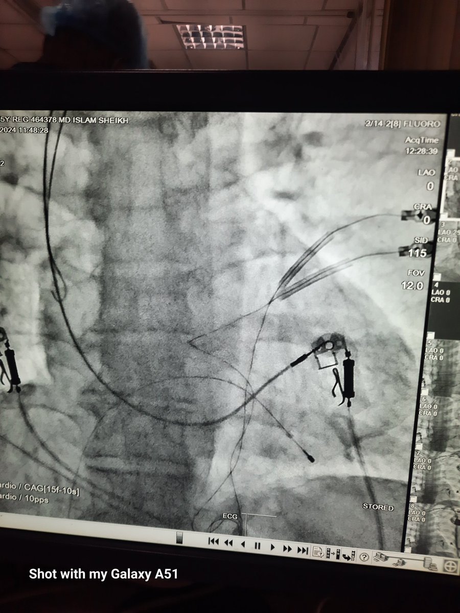 Card_Shariful's tweet photo. Septal pacing
@EuroInterventio 
@ESC_Journals 
@EuroPCR2024
@InterventionCardiologist https://t.co/mKcmicVXhx