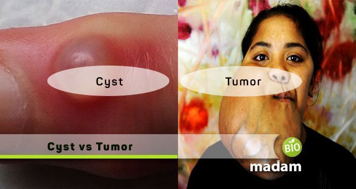 Uncover the mysteries of Cysts vs Tumors in our latest post! Dive into the differences and similarities between these common medical terms. Don't forget to visit our website for the full article biomadam.com/cyst-vs-tumor #CystVsTumor #HealthAwareness #MedicalInsights #LearnMore