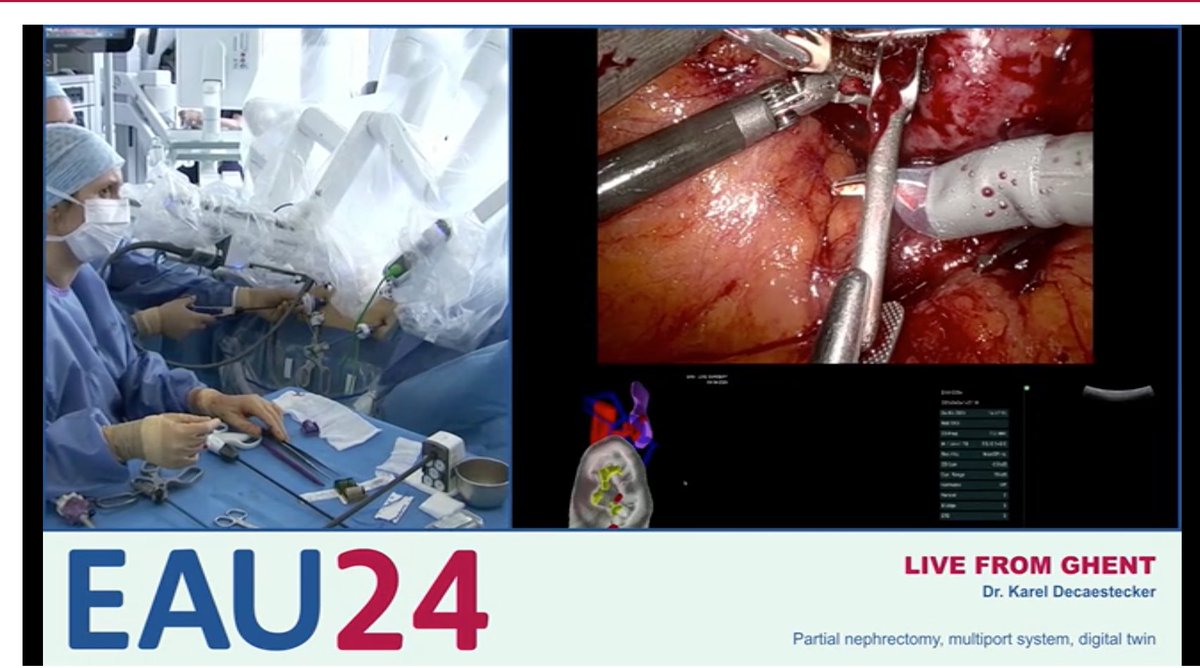 Dr. Karel Decaestecker has successfully completed a complex partial nephrectomy at #EAU24. His skillful use of multiport system & digital twin tech showcases the future of urological surgery! #surgerydone #medicalinnovation