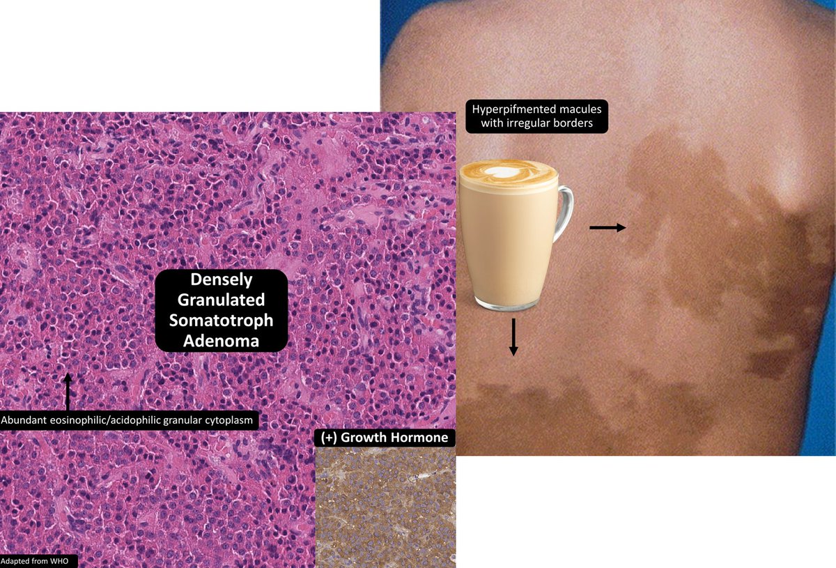 ✅McCune-Albright Syndrome
GNAS mtn (Gs-α subunit) → constitutive acitvation & abnormal cAMP signaling
defined by ≥ 2 of 3: fibrous dysplasia, endocrinopathy, irregular macules*
*aka Café-au-lait spots
#neuropath #dermpath #pedipath #bstpath #pathtwitter #pathresidents