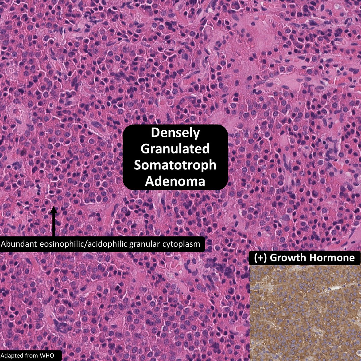 ___ Syndrome = Endocrinopathy + Fibrous Dysplasia + Irregular Macules
A) Sturge-Weber
B) McCune-Albright
C) Brooke-Spiegler
D) Peutz-Jeghers
#neuropath #dermpath #pedipath #bstpath #pathtwitter #pathresidents