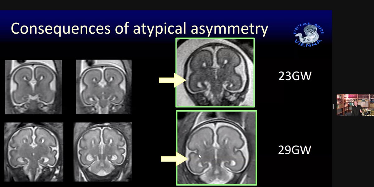 Dr. Gregor Kasprian discussing asymmetry in the acallosal fetal brain vs. normal brain at #IPNTN. There is less asymmetry in the acallosal brain. 

#pedineurorad #neurorad #MedUniVienna