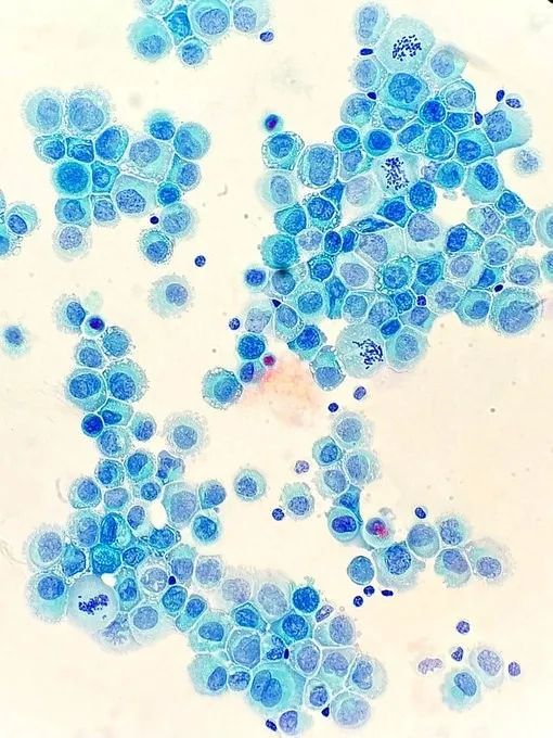 Cerebrospinal fluid revealing large, mitotically active cells. What is the diagnosis? Answer: buff.ly/3tOGWfM #PathArt #PathTwitter #MedTwitter #CytoPath