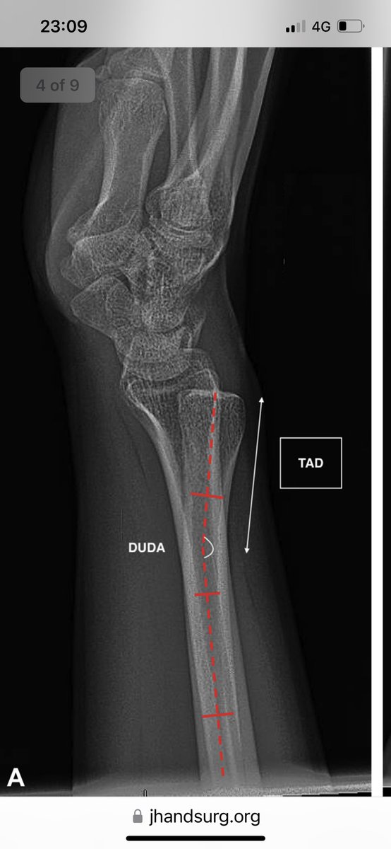 I think in some of these hyperpronation injuries. The “bendy” ulna gets blamed for plastic deformation as the cause of the “Montegia”. When it’s not the Ulna. There is significant variation in the PUDA and the DUDA. jhandsurg.org/article/S0363-….