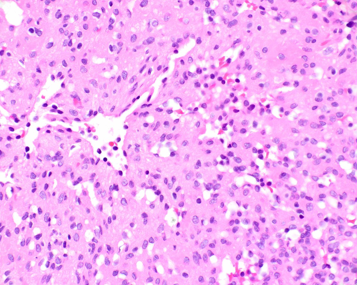 An anastomosing hemangioma presenting as a colorectal polyp. These are uncommon, initially described in the genitourinary tract. They can create concern for angiosarcoma and share mutations with other hemangioma types; PMIDs: 23887160, 19606014, 29574926, 31707589.#UMiamiPath