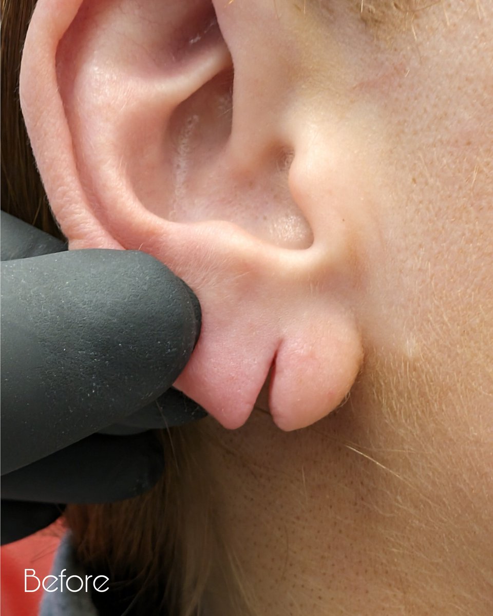 PiercerCharlie's tweet image. Transform your look with our exclusive ear curation services. Our client asked us to cover the earlobe slit and we found this creative way to decorate her earlobe! 💫✨ #ExclusivePiercings #PrecisionStyling #ElegantAdornments #EarArtistry&quot; piercercharliescreations.ie/piercing/