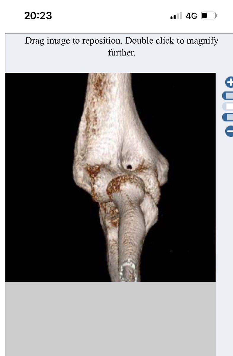 Here in an adult, so incredibly unlikely to have plastic deformation of ulna. Better pictures in this article, see how medial ulno humeral joint opening in keeping with hyperpronation and injury to posterior band of MCL (pMCL - blue) ncbi.nlm.nih.gov/pmc/articles/P…