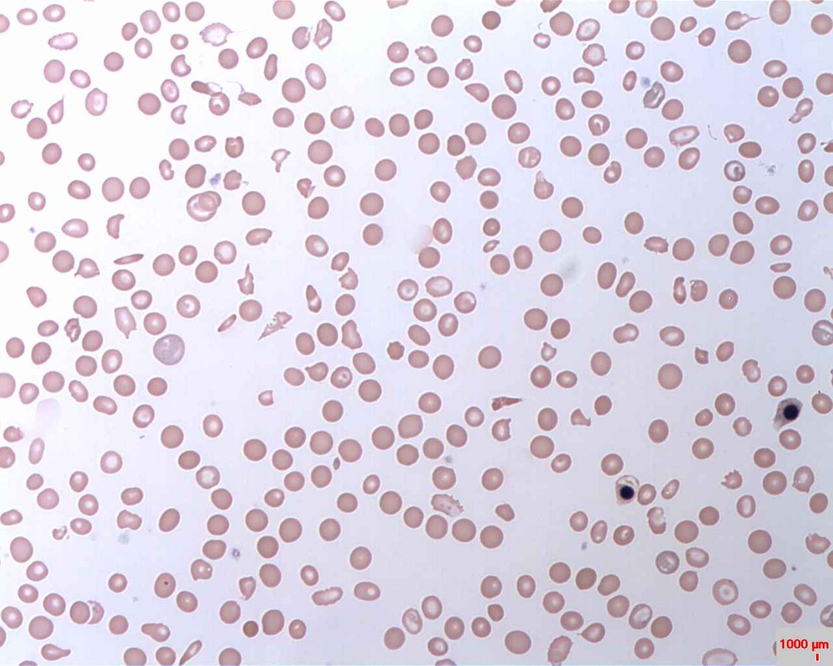A  60yr ♀️ presents with complaints of fatigue,dyspnea,jaundice,and dark urine especially in the morning.PMH;HTN & recent cerebrovascular accident. Blood smear 👇. 
What is the diagnosis?
What is the cause? 
Diagnostic test?
Treatment? 
Complications? 
#MedTwitter #MedX #MedEd…