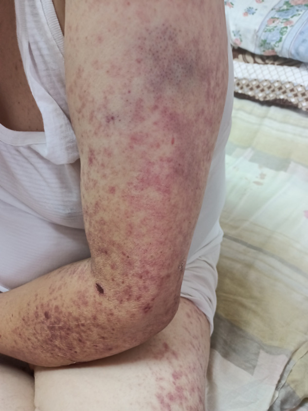 This is the case of a 58year-old man presenting with fever, arthralgias and vascular purpura on his limbs associated with acute kidney failure requiring hemodialysis nine days after the Chinese #Sinovac-#CoronaVac COVID-19 vaccine.
ncbi.nlm.nih.gov/pmc/articles/P…