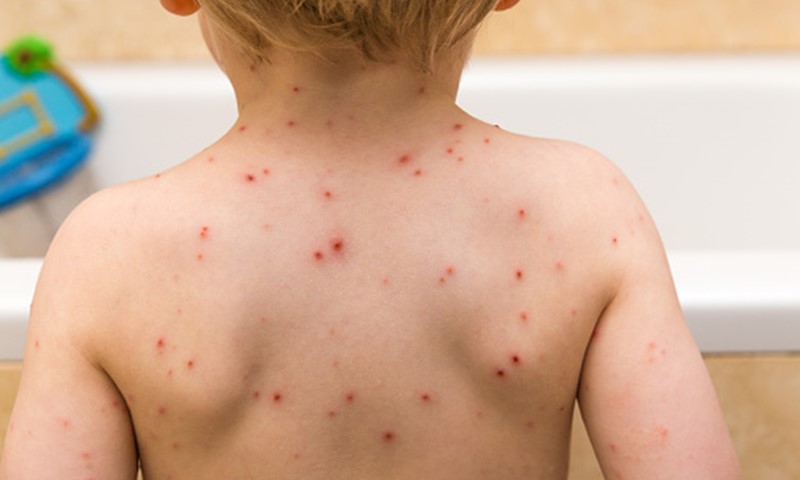 chilli_milli5's tweet photo. Chickenpox is a very contagious infection that causes an itchy, spotty rash. Read NHS information about chickenpox symptoms and when to get medical advice.The Incubation period is 10 to 20 Days.
#Medical_Knowledge #About_Medical #Chikhenpox #bigbrothernlbe #lufc https://t.co/89xlvWivrL