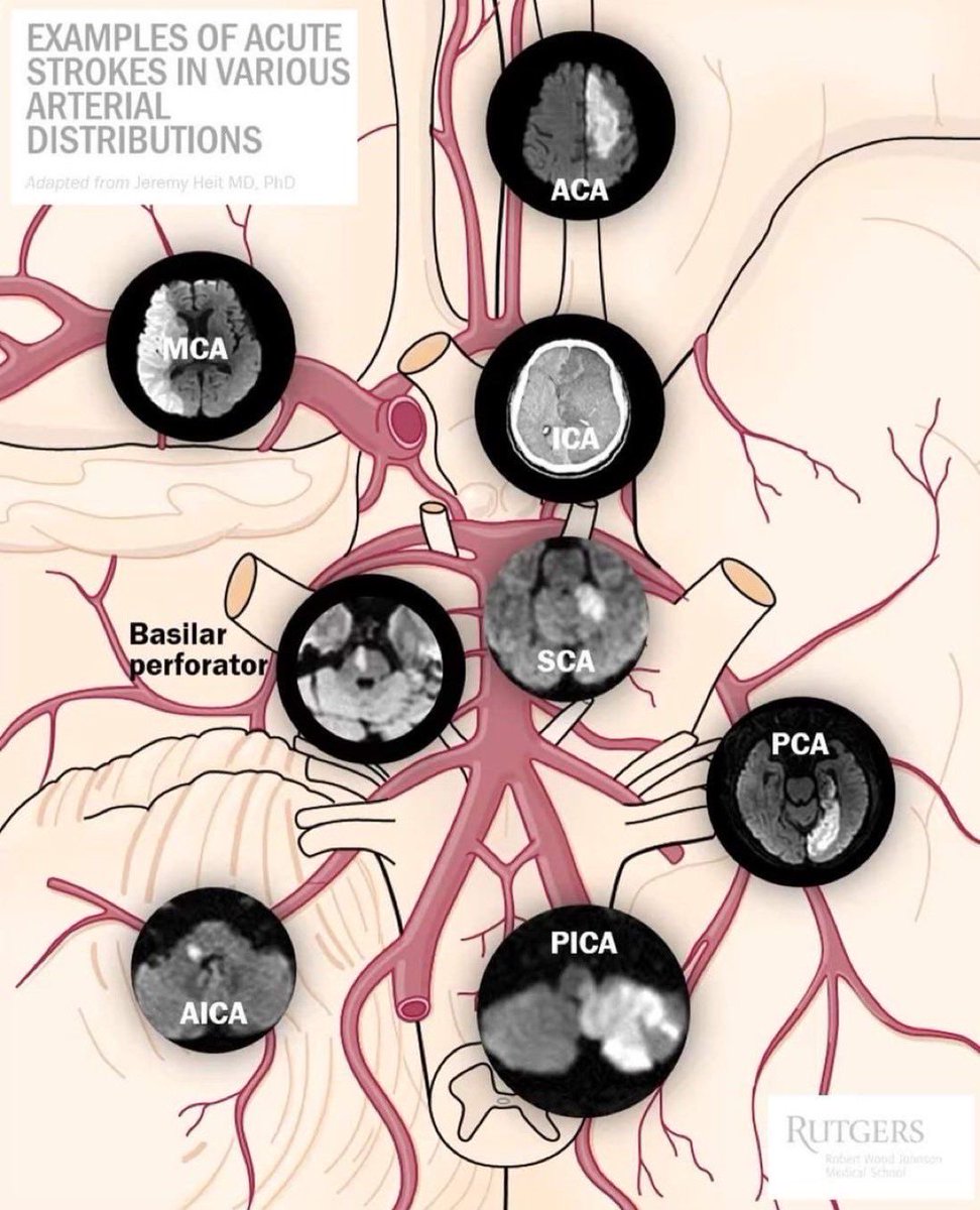 Circle of Willis and Stroke location from Rutgers