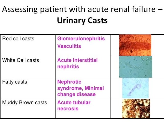 -White cell casts = renal tubule inflammation or infection, acute pyelonephritis (UTI ascension)
-Hyaline casts = MC in NL urine; Benign, concentrated urine, pre-renal
-RBC casts = glomerular dz, bleeding, nephritic
-Granular casts = tubular damage
-Fatty casts = nephrotic