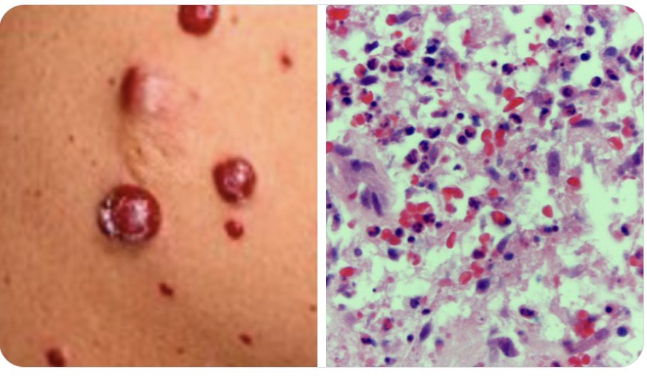 #idboardreview 50 M RA on etanercept: Fever & purple nodules on arms x2wks. wbc30k 95%lymph, multiple sex partners, +fishing/camping, cleaned alley & scratched by rats, cats. Biopsy lobular endothelial cells w/vascular proliferation. dx? #medEd #idmedEd #idtwitter #idxposts