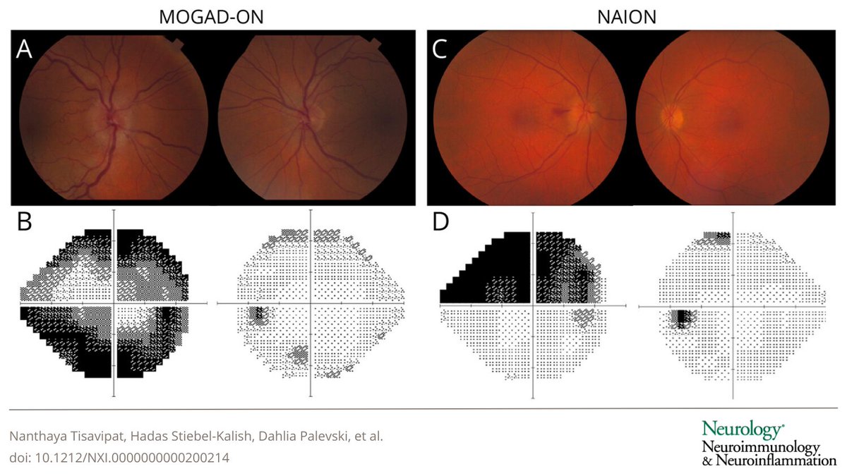 Acute Optic Neuropathy in Older Adults: Differentiating Between #MOGAD Optic Neuritis and Nonarteritic Anterior Ischemic Optic Neuropathy bit.ly/43FYFE9 #NAION #NeuroTwitter