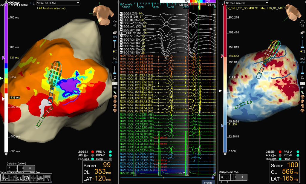 Already on going #EHRA2024 !! Amazing program! Thbks @SergeBoveda and Andrea Sarkozy! @EHRAPresident @purerfellner . Honoured to present an epicardial VT case with Dr Marchlinsky and Dr Silberbauer, are you gonna miss it? @hospitalclinic