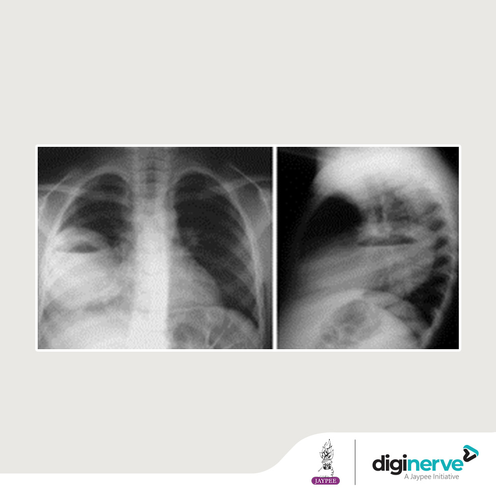 A 40-year-old male came with a complaint of high-grade fever, dry cough & chest pain for past 10 days. He is a known case of TB. What is the most likely cause? 

A. Lung Abscess
B. Suppurative Pneumonia 
C. Atelectasis 
D. Pleural effusion

#DigiNerve #NerveCrackin #QuizTime