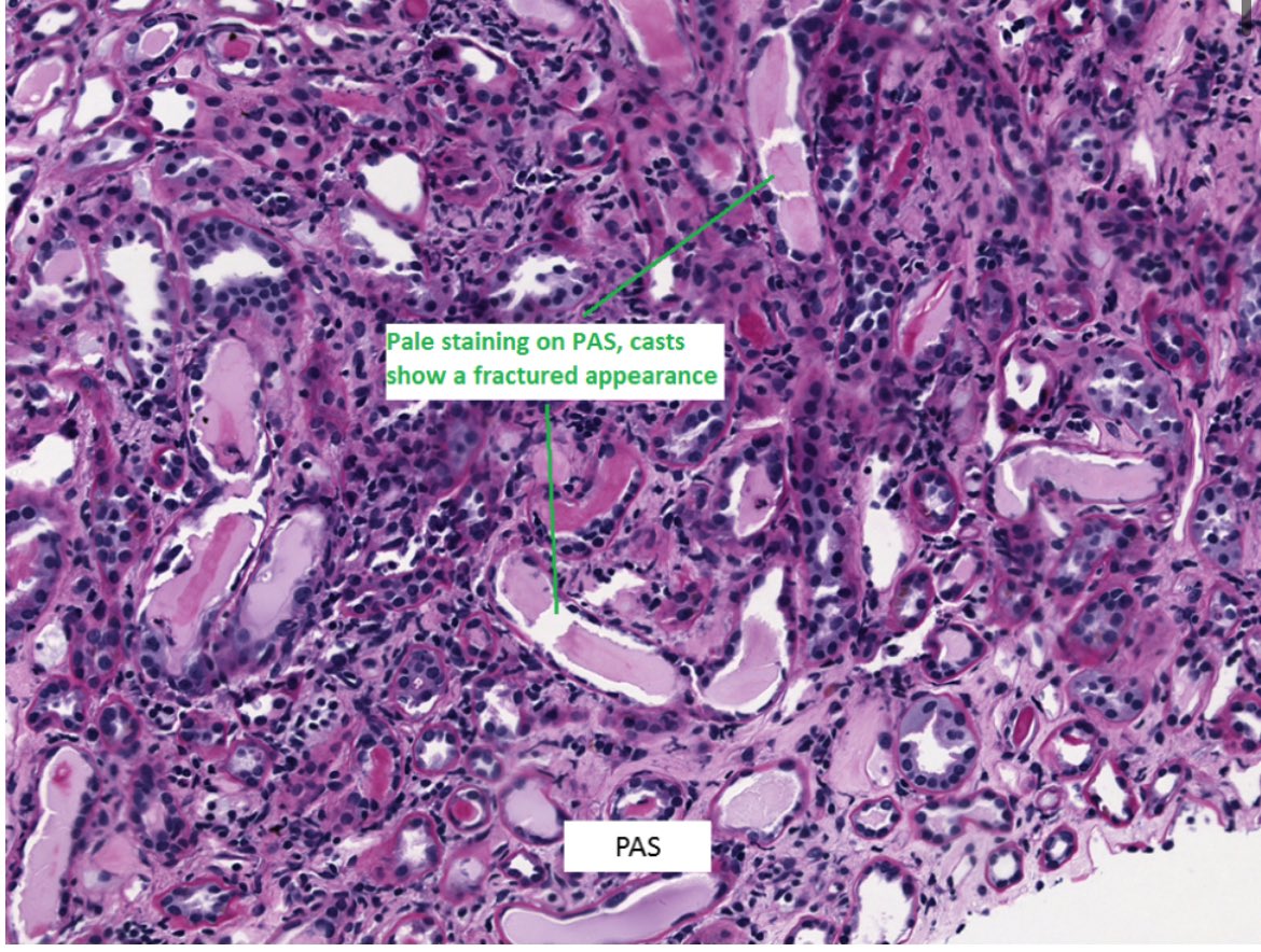 🔬Myeloma cast nephropathy kidney biopsy 

1️⃣Casts have fractured appearance on LM-Rigid casts 

2️⃣PAS negative 

3️⃣Casts surrounded by inflammatory reaction of giant cells/macrophages 

renalfellow.org/2019/08/26/kid…

@RenalFellowNtwk 

At onconeph symposium @MMMNephro @onconephsociety