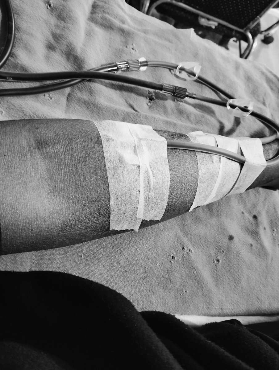 'They puncture my vein, one to extract, one to infuse... Not your typical needle, large as locust thorns, twice weekly. The agony is intense. Yet, the torment of enduring without dialysis dwarfs this pain. Please support me on buymeacoffee.com/helptristian for lifesaving treatment. 🙏