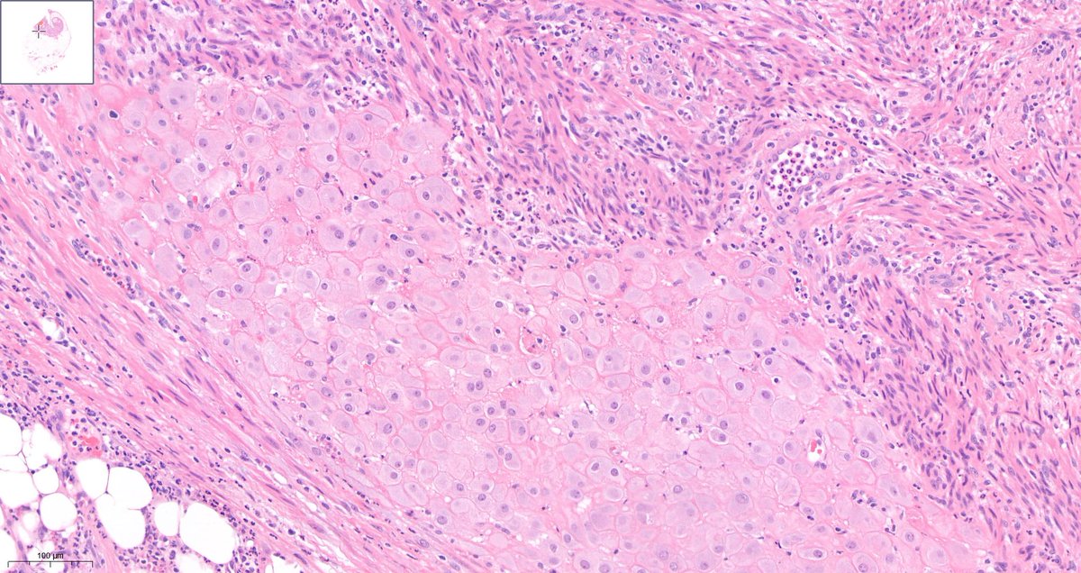 Young woman with appendicitis and these unusual changes at the tip #Pathologists what’s going on here?