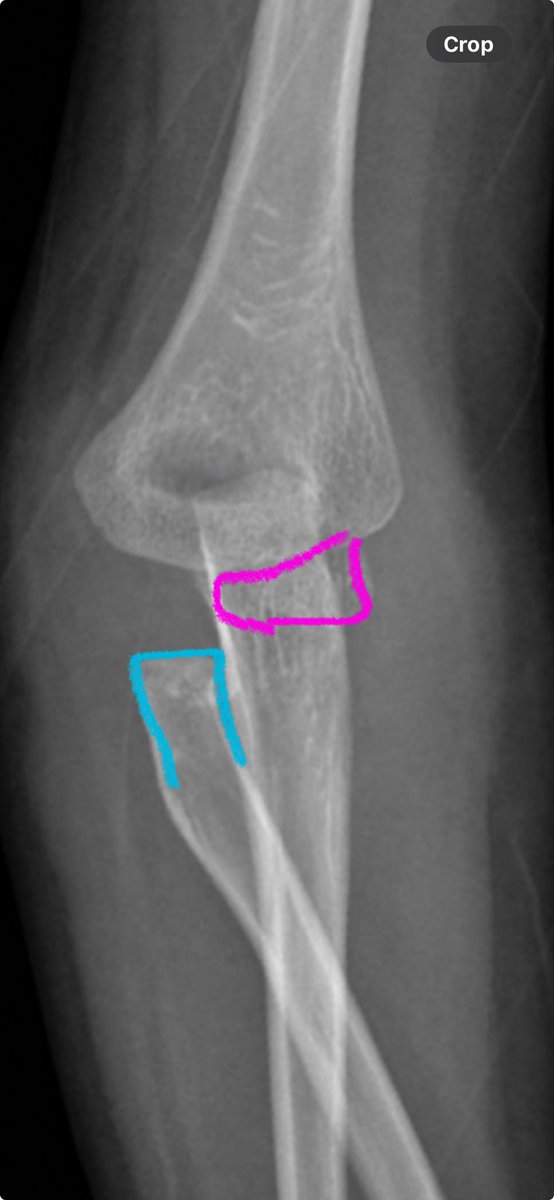 This injury sits in the spectrum of “radioulnar translocation” - hyperpronation. Great example in this case report, 5 year old. At first glance AP might be ok. Important to know capitellum in pink, radial neck in blue. ncbi.nlm.nih.gov/pmc/articles/P…