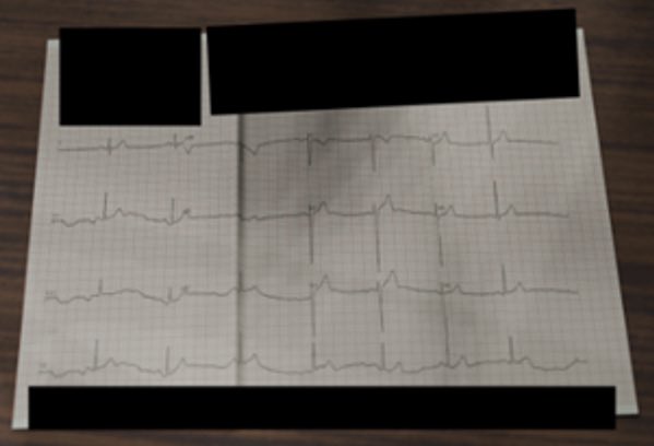 #ehra2024 1/2 Is this ECG real or synthetic? <a href="/CEMRG_/">Cardiac Electro-Mechanics Research Group</a> <a href="/ep_kcl/">KCL EP</a> <a href="/mobernabeu/">Miguel O. Bernabeu</a> <a href="/Ju_Ra_Ga/">Julia Ramírez</a> <a href="/axel_loewe/">Axel Loewe (axel-loewe.bsky.social)</a> <a href="/fleurtjong/">Fleur Tjong</a> <a href="/EmmaSvennberg/">Emma Svennberg</a> <a href="/Dominik_Linz/">Dominik Linz</a>