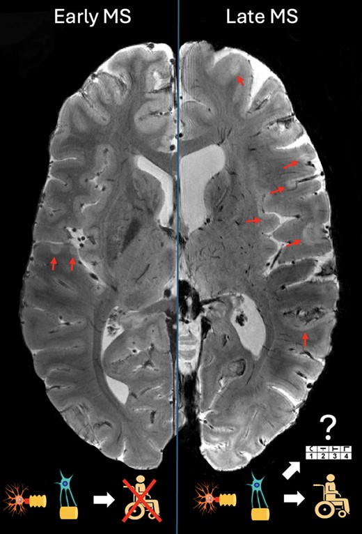 Cortical remyelination in multiple sclerosis: a target for disease monitoring and intervention New scientific commentary by Caterina Mainero, Alessandro Miscioscia & Constantina Treaba tinyurl.com/2yh3zp6h