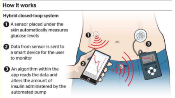 Tens of thousands of children and adults with type 1 diabetes will be offered an “artificial pancreas” on the NHS.The hybrid closedloop system monitors a person’s blood glucose and automatically adjusts the amount of insulin given through a pump. #diabetes #bloodsugar #health