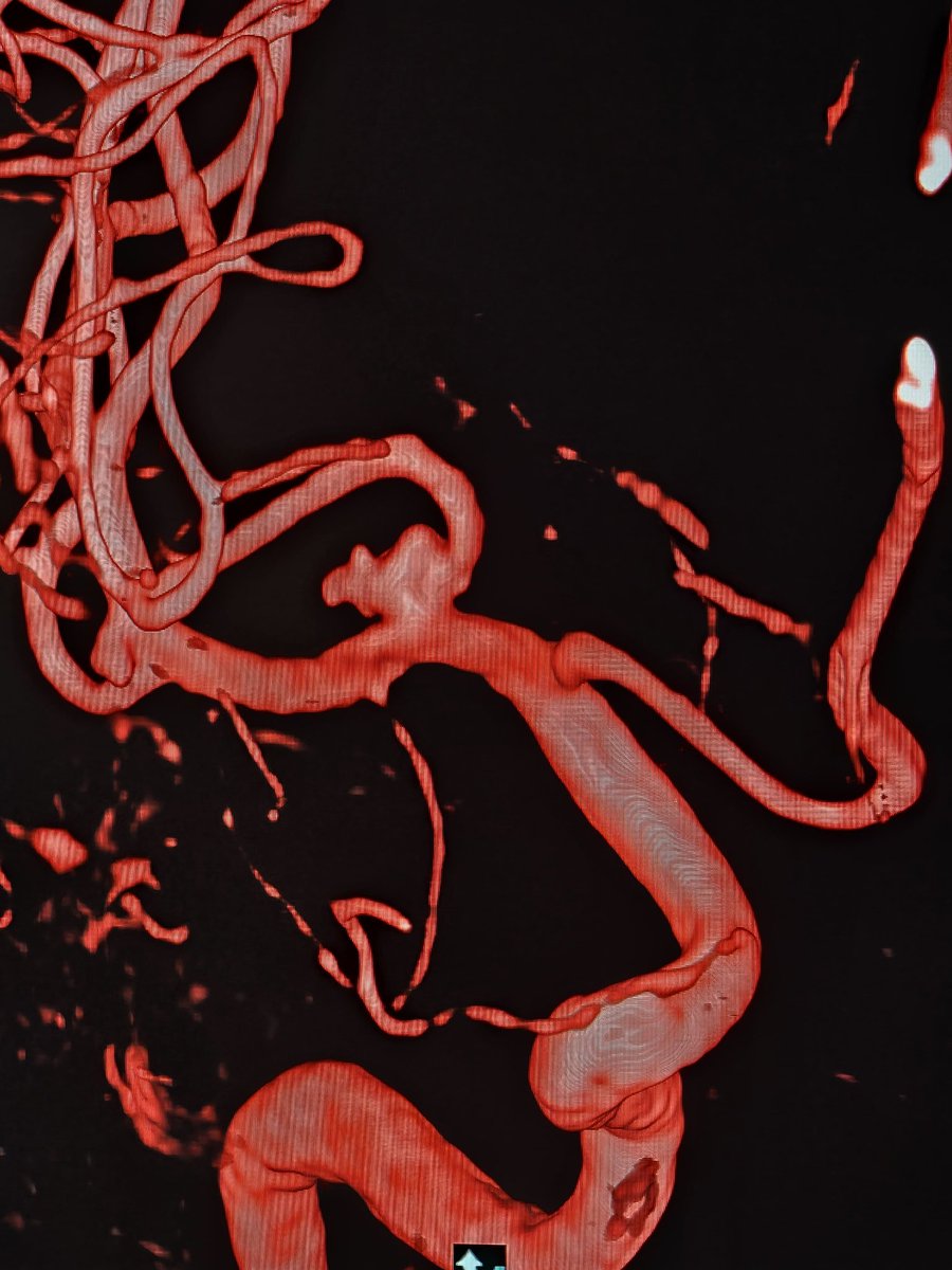 SharathKumarGG7's tweet image. Fischer grade 2 SAH in a middle aged lady. Stent assisted coiling was done for a wide neck middle cerebral artery aneurysm #BrainAneurysm #SAH #Coiling #Stent #BrainHemorrhage #Endovascular #Neurorad #Neurosurgery #Neurointervention