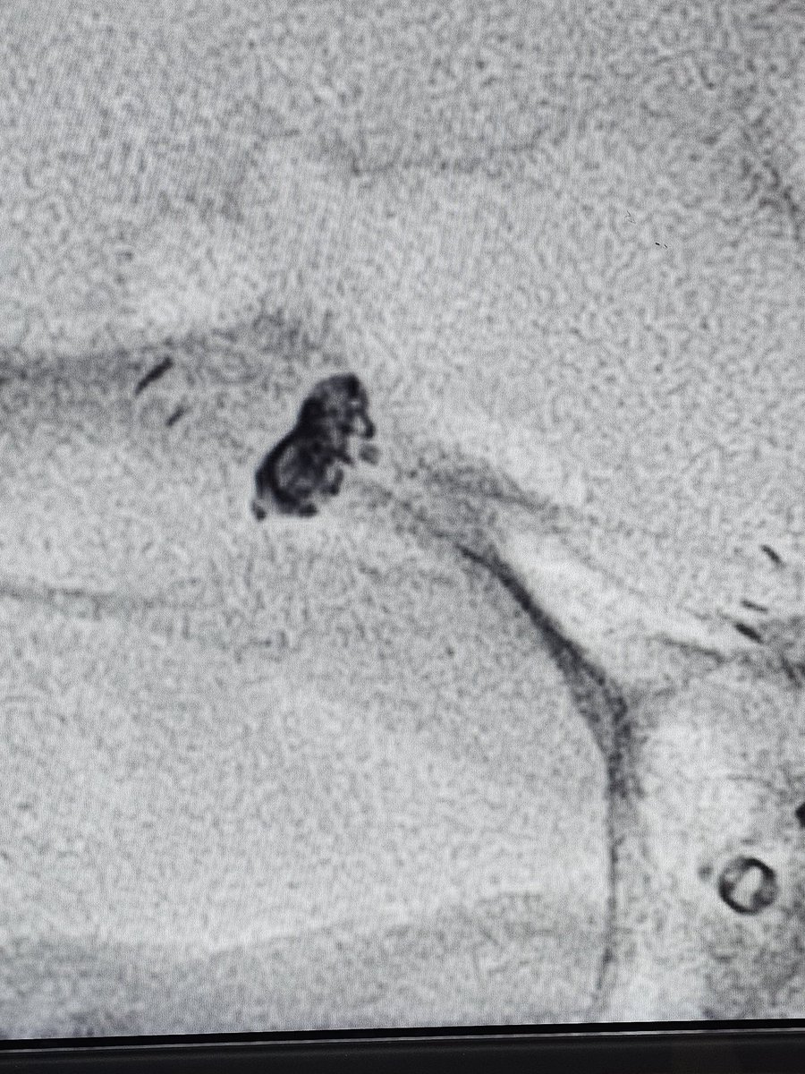 SharathKumarGG7's tweet image. Fischer grade 2 SAH in a middle aged lady. Stent assisted coiling was done for a wide neck middle cerebral artery aneurysm #BrainAneurysm #SAH #Coiling #Stent #BrainHemorrhage #Endovascular #Neurorad #Neurosurgery #Neurointervention