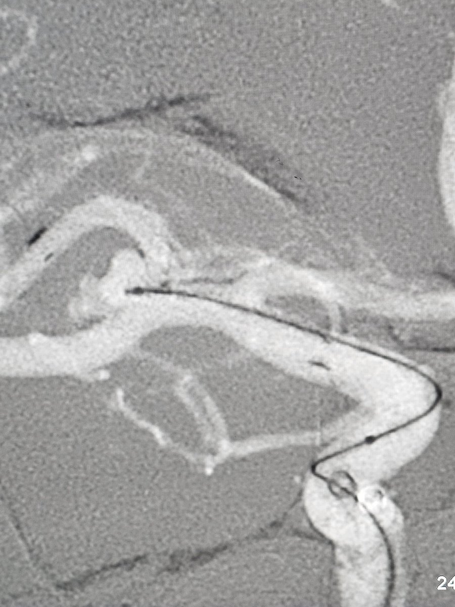 SharathKumarGG7's tweet image. Fischer grade 2 SAH in a middle aged lady. Stent assisted coiling was done for a wide neck middle cerebral artery aneurysm #BrainAneurysm #SAH #Coiling #Stent #BrainHemorrhage #Endovascular #Neurorad #Neurosurgery #Neurointervention