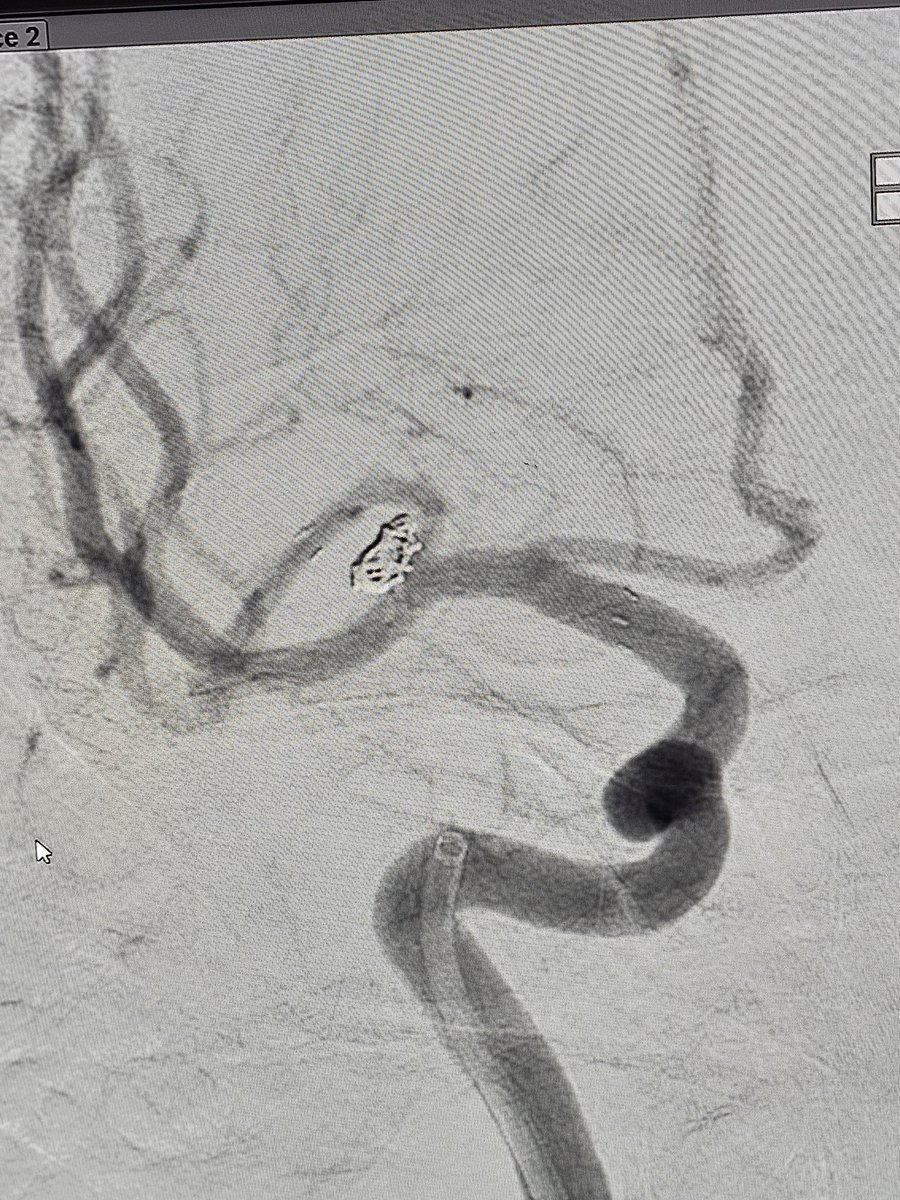 Fischer grade 2 SAH in a middle aged lady. Stent assisted coiling was done for a wide neck middle cerebral artery aneurysm #BrainAneurysm #SAH #Coiling #Stent #BrainHemorrhage #Endovascular #Neurorad #Neurosurgery #Neurointervention