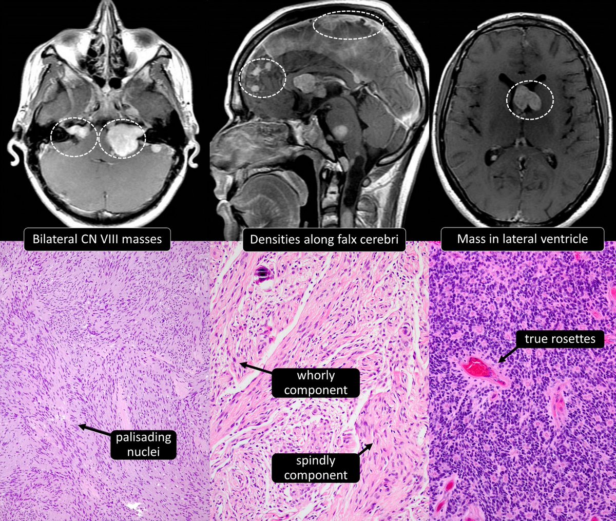 Neurofibromatosis type 1 or 2?
#neuropath #bstpath #pedipath #pathtwitter #pathresidents