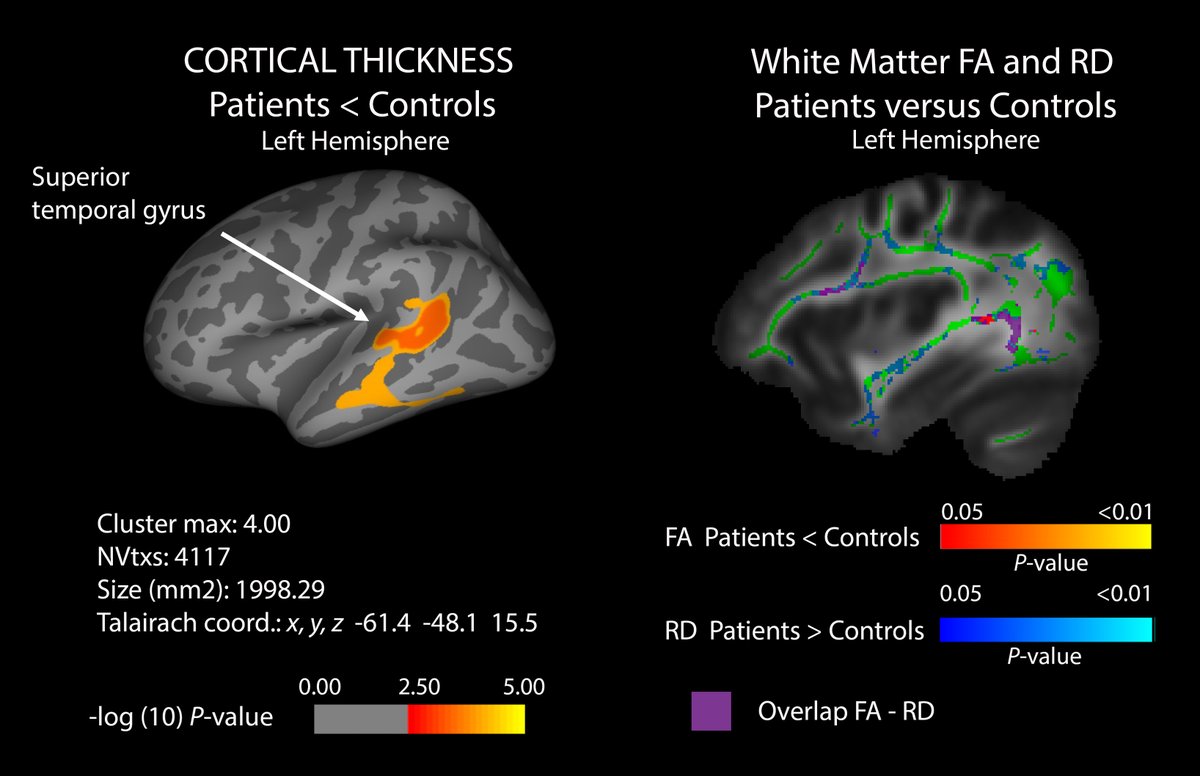 Serrano del Pueblo et al. report that patients with long COVID have cognitive difficulties vs controls who recovered completely from SARS-CoV-2. The cognitive deficits are associated with altered brain connectivity, particularly of white matter regions. tinyurl.com/pbsyuze9