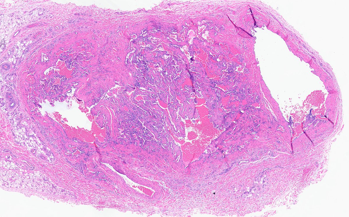 #dermpath  Forearm lesion.
WOW.