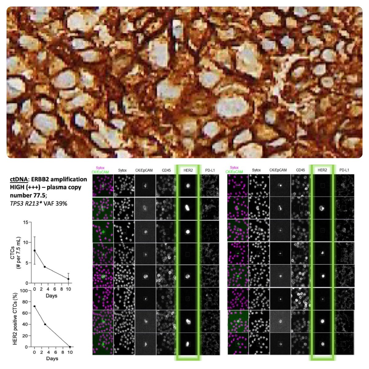 pashtoonkasi's tweet image. Timely #AACR24 with the 1st approval of an agnostic ADC for HER2-positive cancers.

?debate on criteria.

My 2 cents: the true HER2➕➕➕ are hard to miss🔬.

💡➕it’ll be corroborated by ERBB2 🧬 amplification on other tests #ctDNA #CTCs.

Approval🔑➡️access.👇🏾is HCC. @OncoAlert