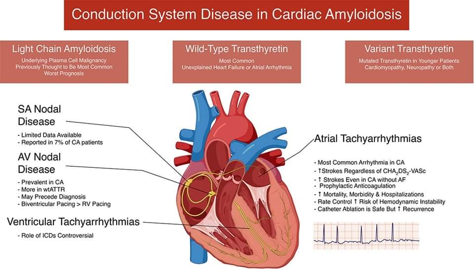 🔴 Conduction system disease in cardiac amyloidosis #openaccess  ##2023review 

sciencedirect.com/science/articl…
 #meded #medstudent #MedEd #Cardiology #CardioTwitter #cardiotwitter #cardiotwiteros #CardioEd #MedTwitter #MedX #cardiovascular #ECG #medtwitter #FOAMed #paramedic