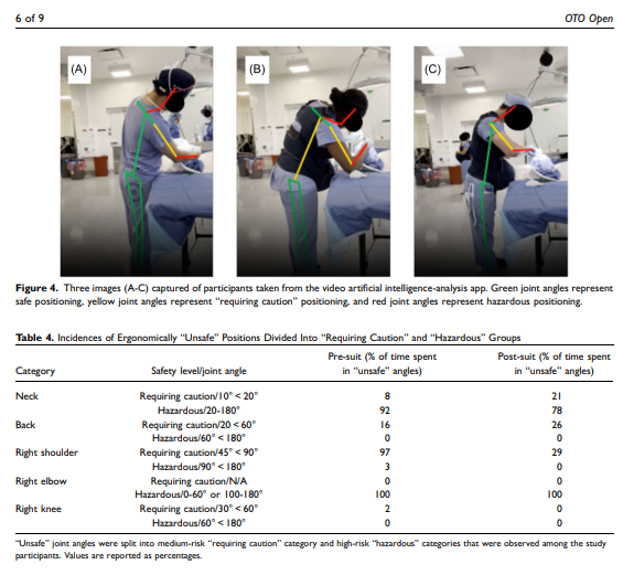 Interesting study characterizing ergonomic risks among OHNS trainees performing septorhinoplasty using a simulation suit to mimic physiological changes that occur in pregnancy @AAOHNS @FilipinoSurgeon @UCSFSurgery @OTOjournals …-hnsfjournals.onlinelibrary.wiley.com/doi/pdfdirect/…