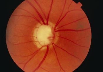 Spot diagnosis?
Hint: optic disk cupping

A- papilledema
B- glaucoma
C- cataract

#Usmle #DrSam👩🏼‍⚕️🩺 #medtwitter #match2024 #match2023 #ecfmg #ecfmgcertificate