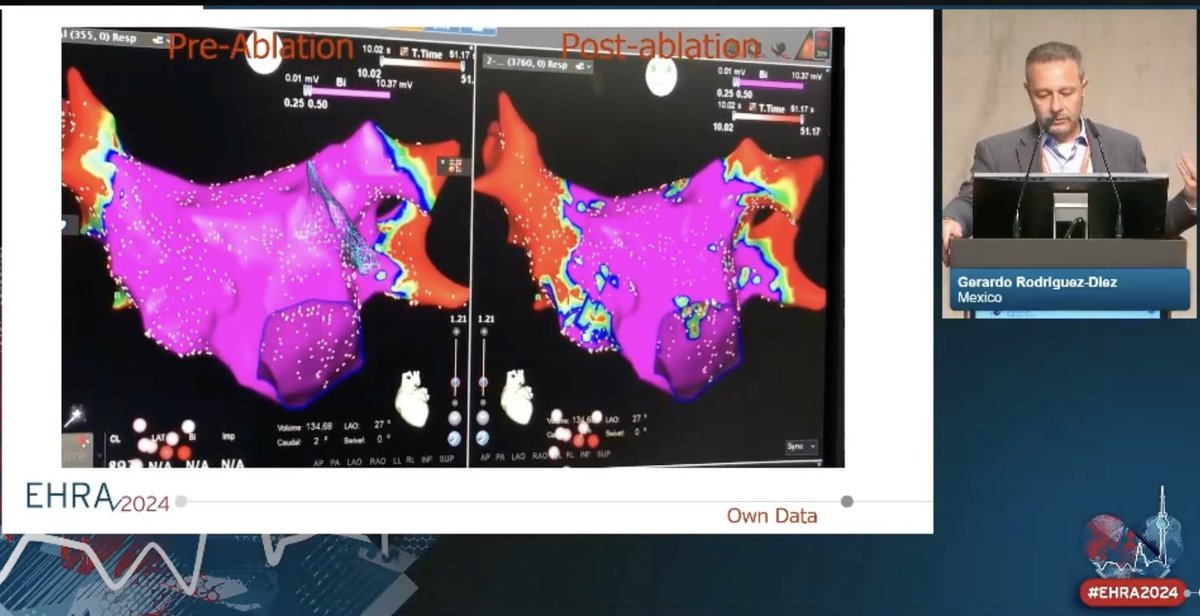 Joint Session EHRA-LAHRS at #EHRA2024 Happening now¡¡¡ You can join us online💻 and onsite Dr. @gerarod10 🇲🇽 “lesion characteristics and durability: RF vs Cryo”