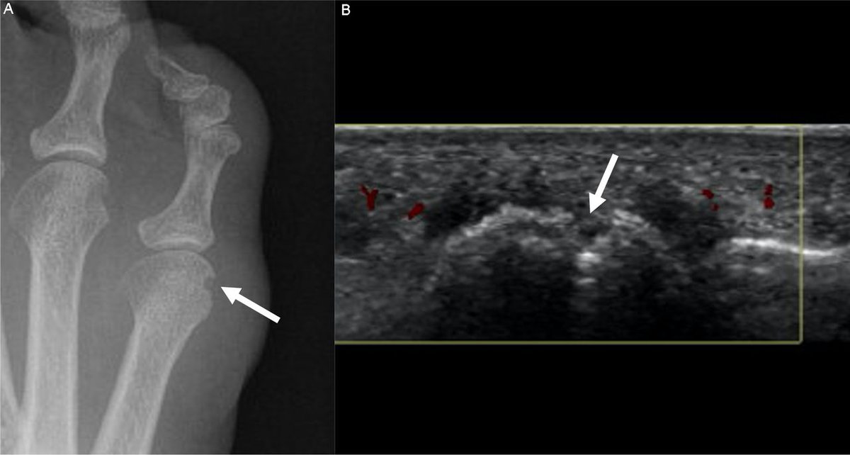 📢Our new paper just published! ▶️Erosions seen in 25% of patients with newly diagnosed untreated #PsoriaticArthritis ➡️A focused #ultrasound of the wrist, 2nd MCP & 5th MTP joints may be useful to detect bone #erosions in early #Psoriatic #Arthritis 👉🏽rmdopen.bmj.com/content/10/2/e…