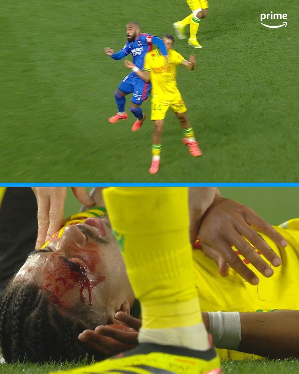 D’accord 

#FCNantes #FCNOL #Lacazette #OL #Ligue1 #Ligue1UberEats #Arbitrage #VAR